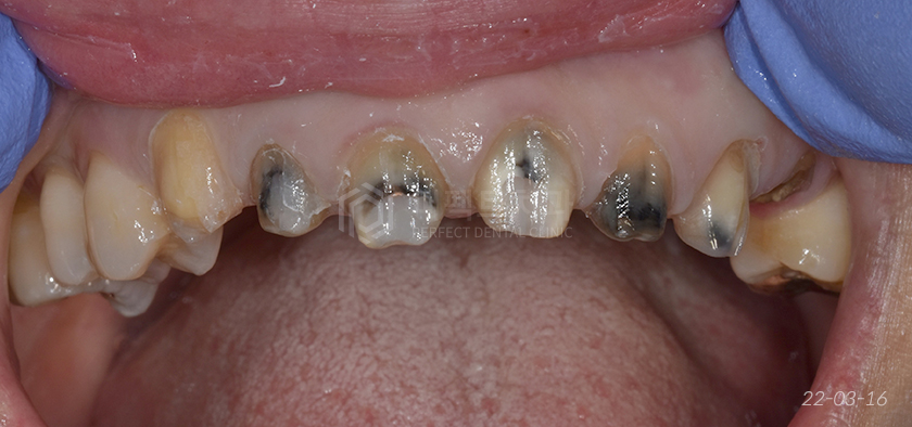 라미네이트를 뜯어보니😨..충격주의 #앞니신경치료 관련 이미지 5