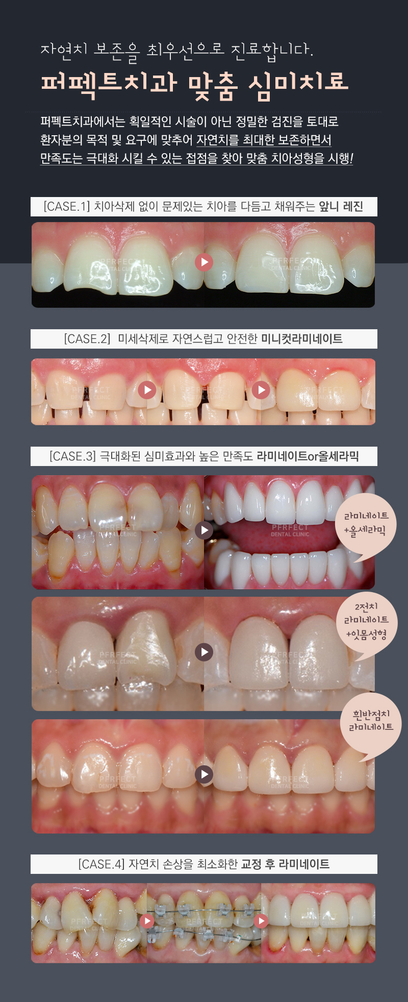 앞니 라미네이트 관련 이미지 12