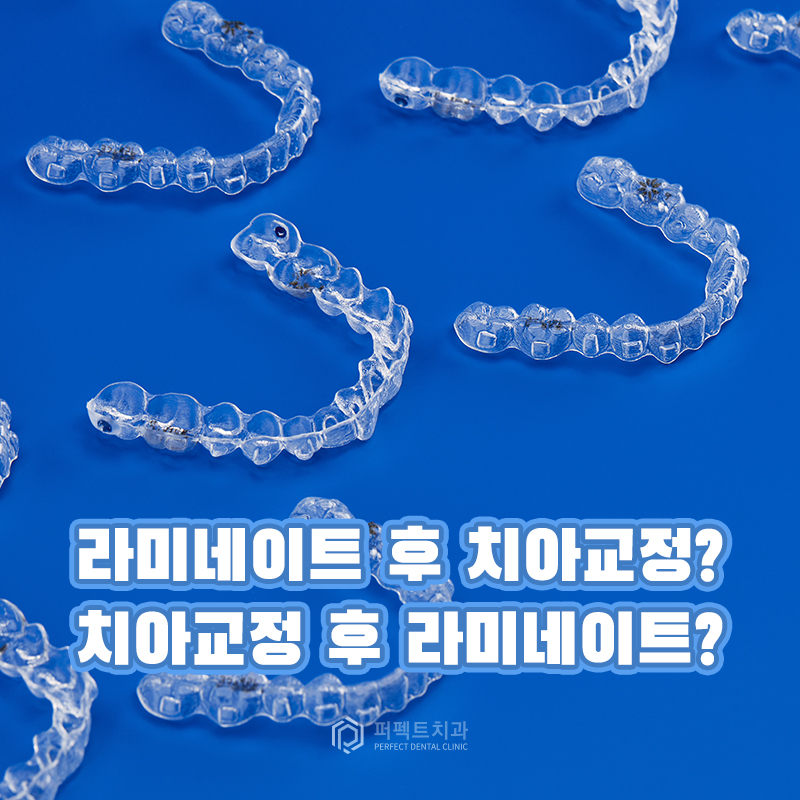 라미네이트 후 치아교정 시 알아아야 할 점은? 관련 이미지 1