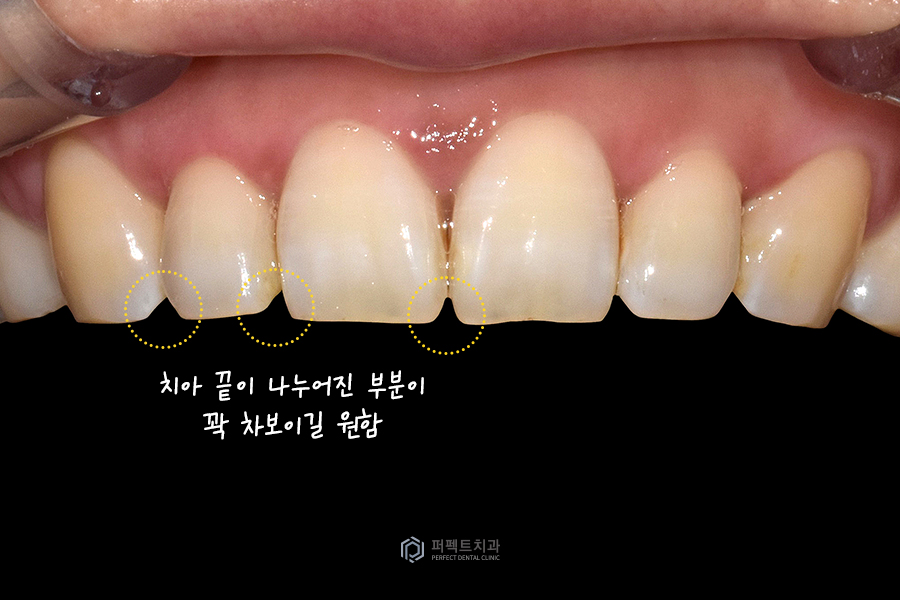 라미네이트 디자인👄｜치과의사가 고른 것vs환자가 고른 것, 어떤 걸로? 관련 이미지 2