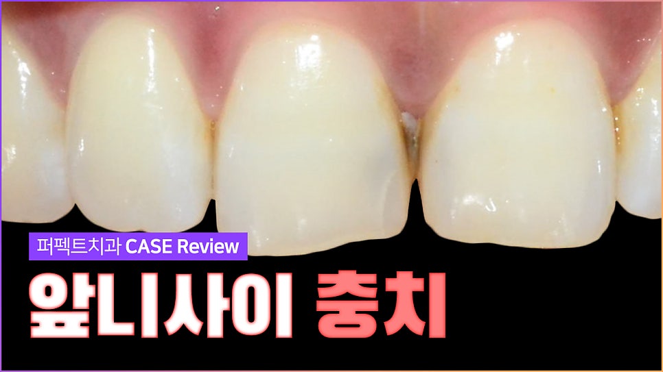 앞니 사이 충치치료와 폴리네이트 관련 이미지 1