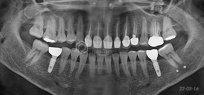 라미네이트를 뜯어보니😨..충격주의 #앞니신경치료 관련 이미지 2