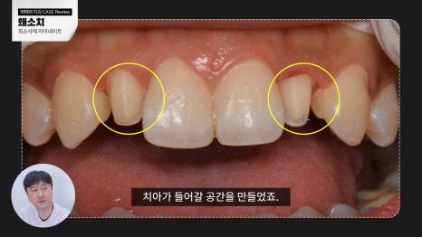 주변 치아보다 작은 관련 이미지 5