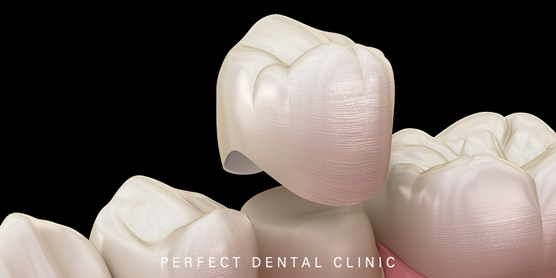 충치치료 단계와 치료방법 관련 이미지 3