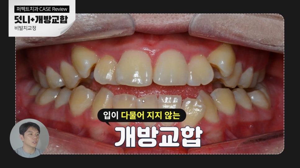 덧니+개방교합, MARPE를 이용한 비발치교정 관련 이미지 2
