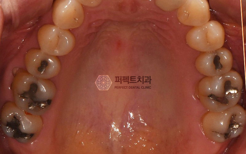 앞니 충치 레진 비용 알아보기! 관련 이미지 2