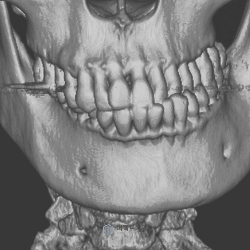 턱관절 안 좋은데 치아교정 가능할까요? 관련 이미지 2