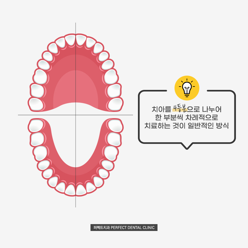 다수의 임플란트 식립시 어떤 문제점이? 관련 이미지 2