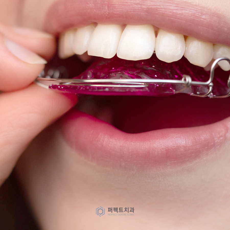 라미네이트 후 교정 유지장치는? 관련 이미지 2