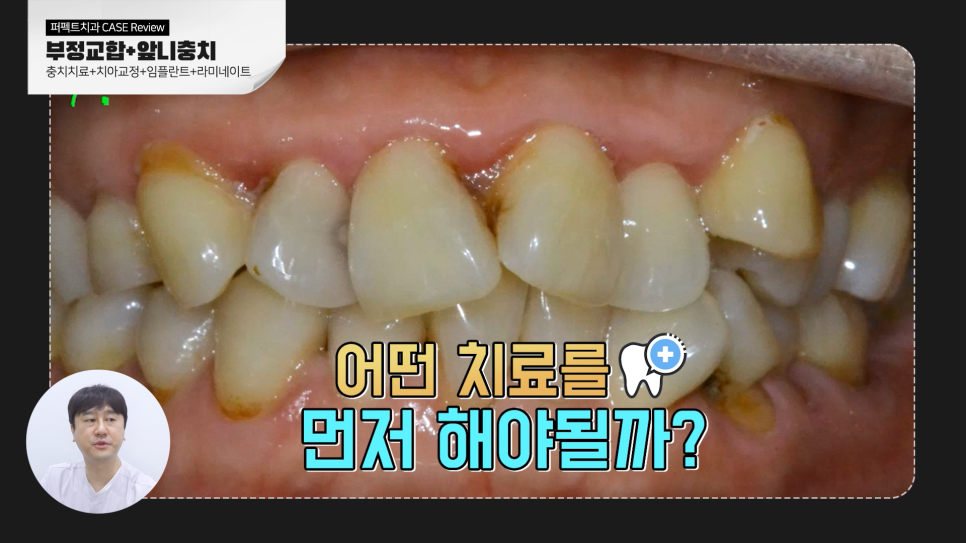 [부정교합+충치] 복합적인 문제를 가진 치아, 치료결과는? 관련 이미지 2