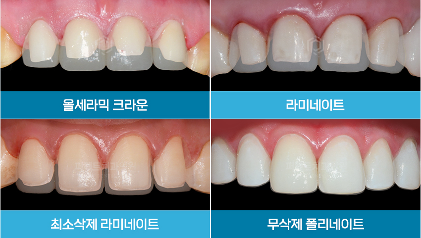 라미네이트 치료 시 참고사항은? 관련 이미지 3