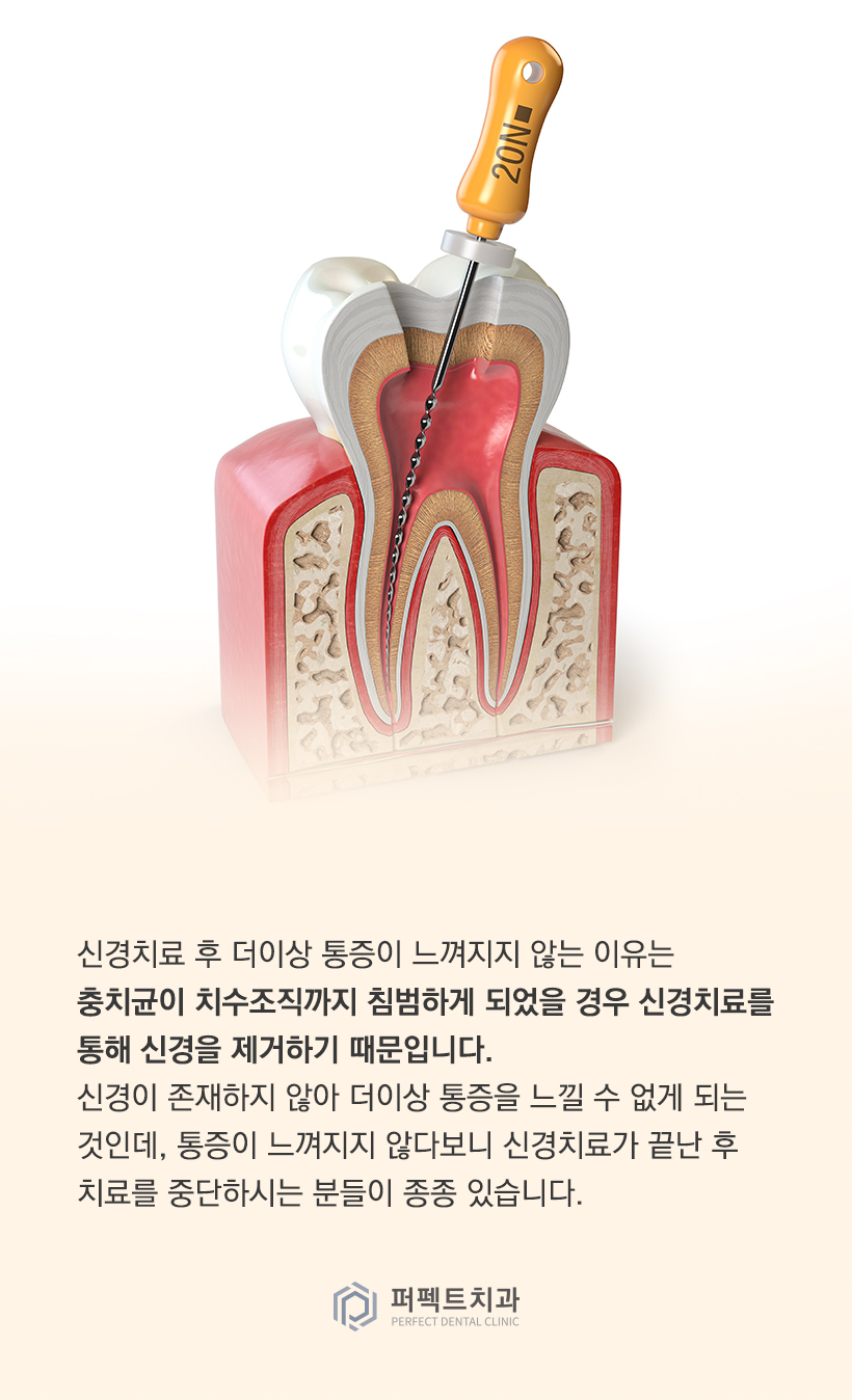 신경치료 후 크라운이 꼭 필요한 이유는? 관련 이미지 2