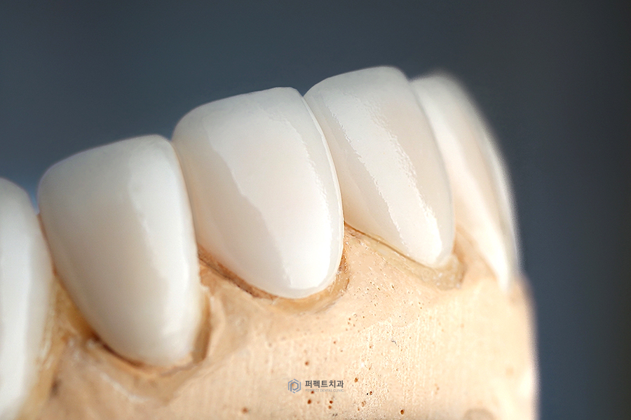 라미네이트로 치아교정 할 수 있나요? 관련 이미지 2