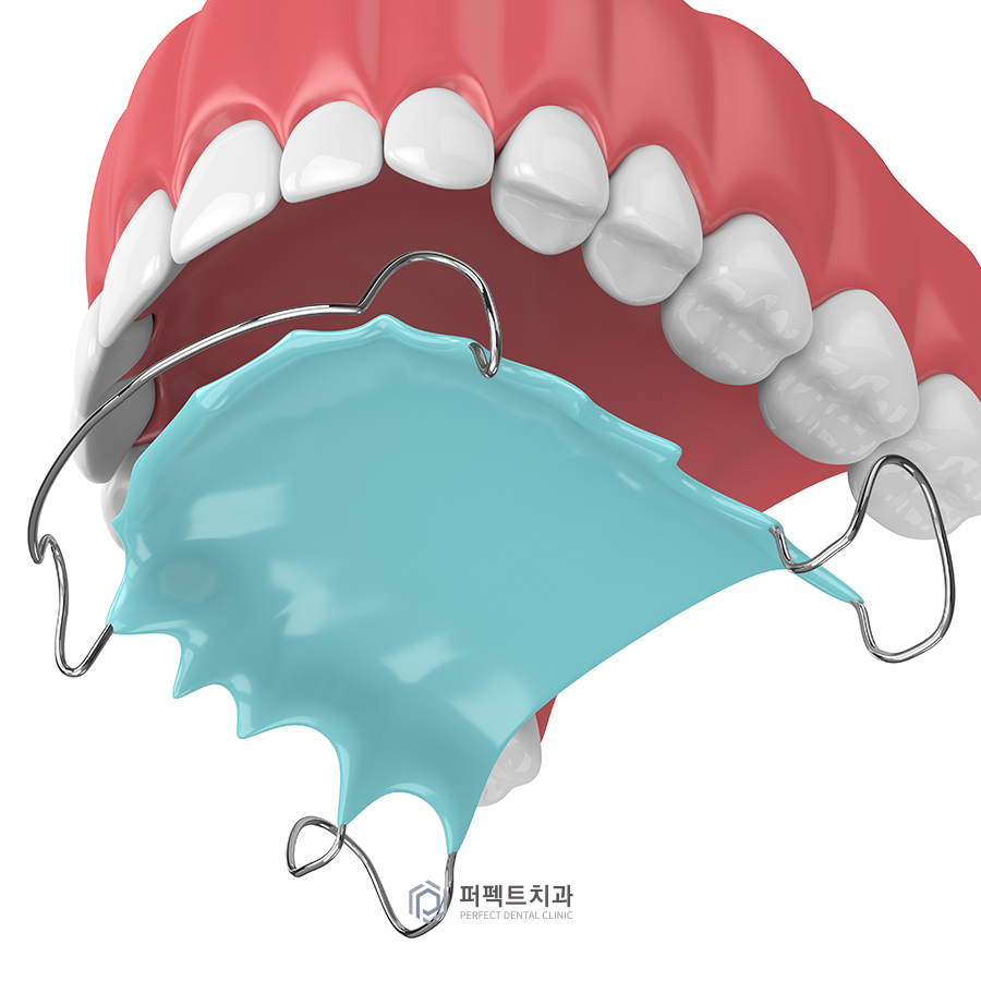 라미네이트 후 교정 유지장치는? 관련 이미지 4