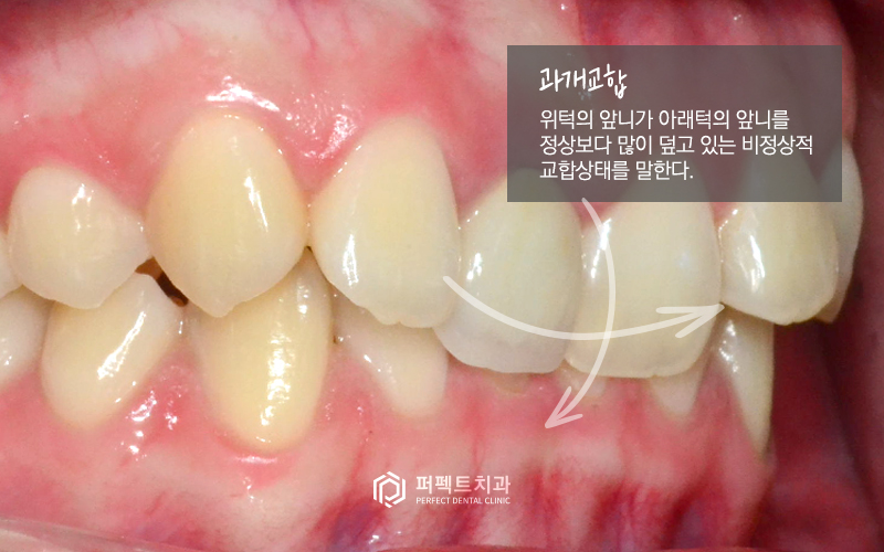 벌어진앞니 무삭제라미네이트 케이스 관련 이미지 6
