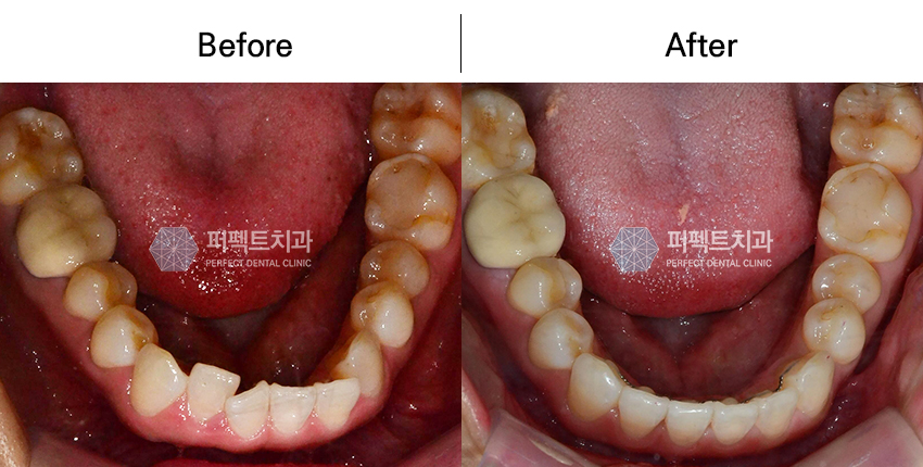 3개월 단기교정으로 빠르게! 관련 이미지 3