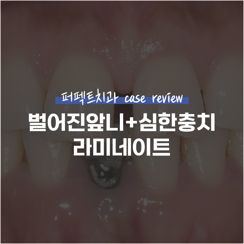 충치+벌어진앞니 라미네이트 case 관련 이미지 1