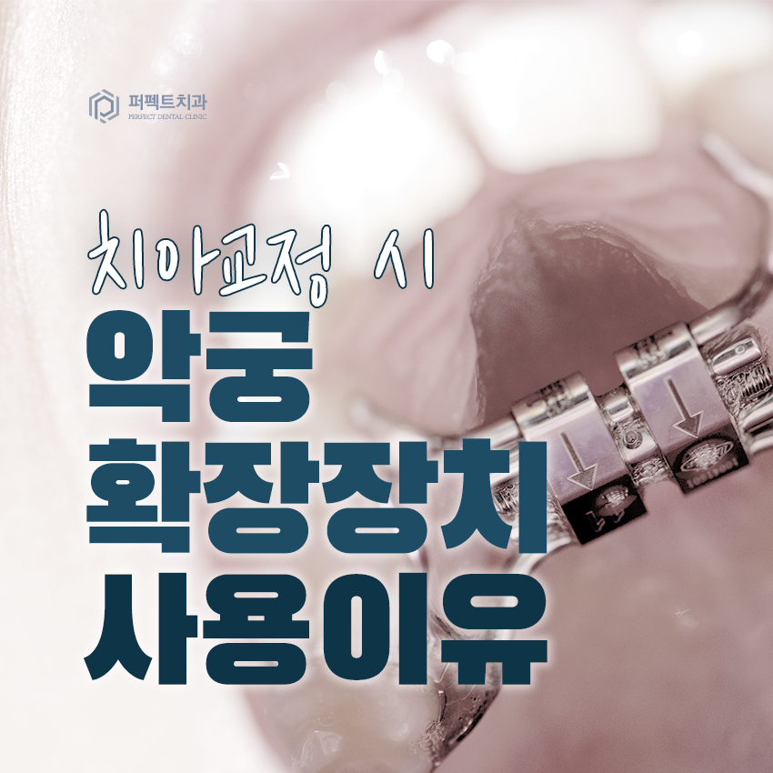 턱을 넓히는 악궁확장장치(MARPE), 왜 사용하는걸까? 관련 이미지 3