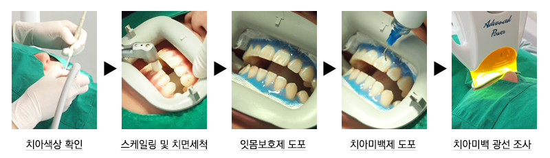 누런이를 하루만에! 원데이 치아미백 관련 이미지 2