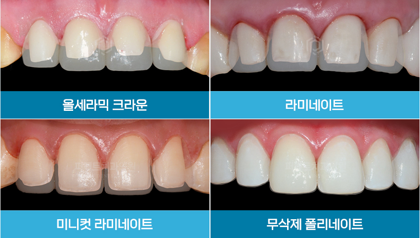 라미네이트 치료 시 참고사항은? 관련 이미지 3