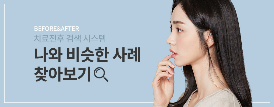 無통증&middot;무마취 라미네이트, 폴리네이트 치료 결과 관련 이미지 2