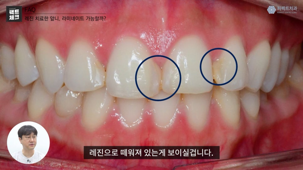 레진으로 치료받은 앞니도 라미네이트 가능한가요? 관련 이미지 5