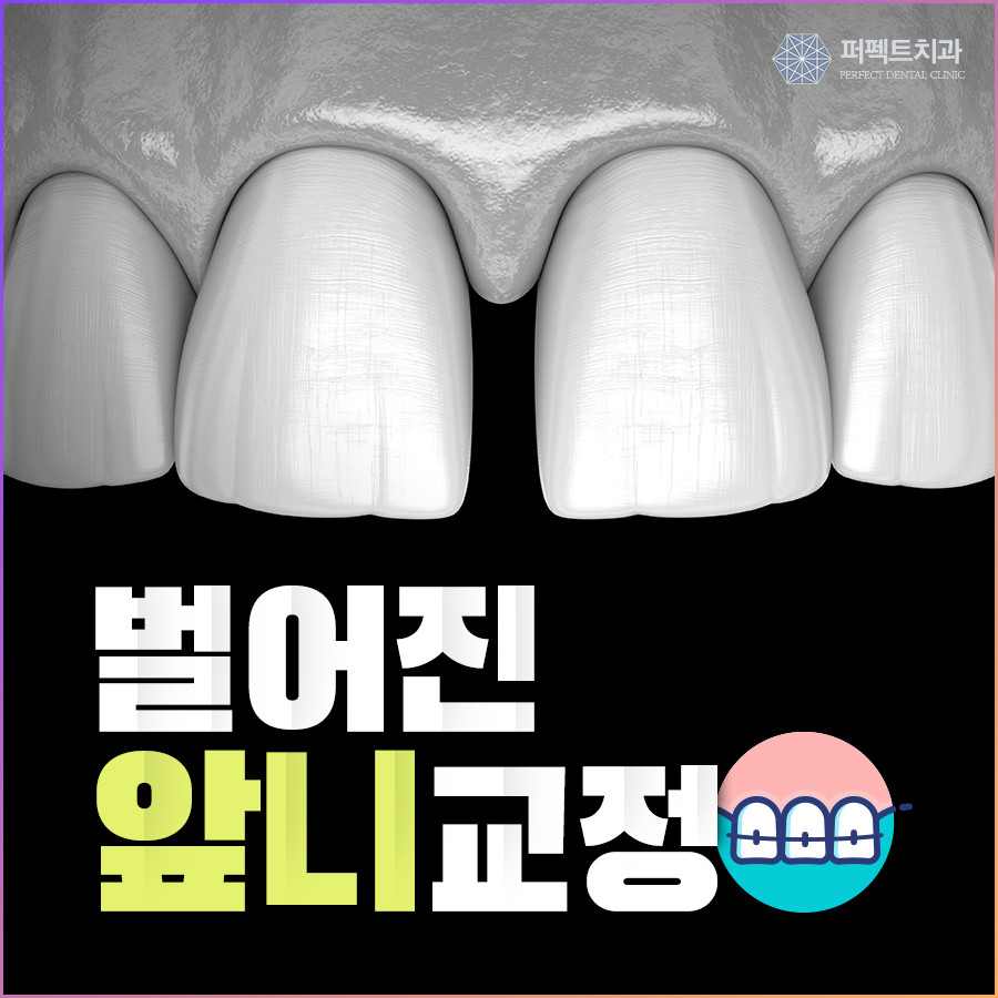 벌어진 앞니, 간단한 교정치료 관련 이미지 1