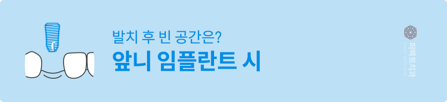 임플란트 후, 발치된 빈 공간이 걱정된다면? 관련 이미지 1