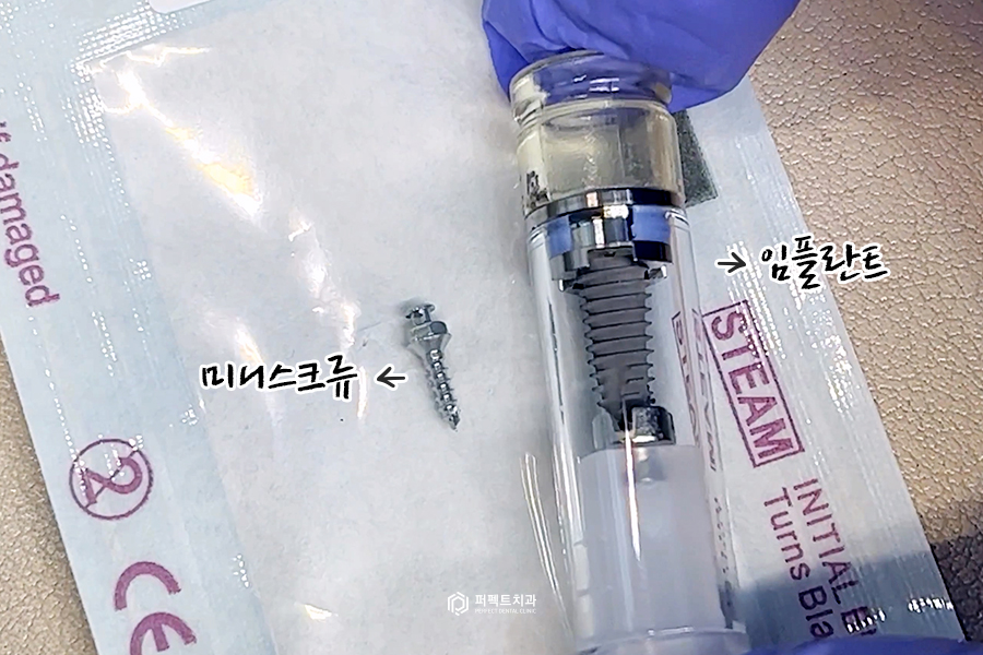 미니스크류｜치아교정 시 잇몸에 심는 나사는? 관련 이미지 2