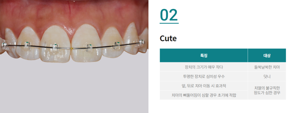 벌어진앞니교정, 원인부터 해결 방법까지 관련 이미지 6