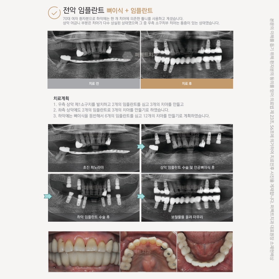틀니 사용 시 주의사항, 틀니에서 임플란트로 가능!? 관련 이미지 5