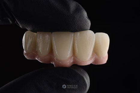 임플란트 후 임시치아, 임시틀니① 관련 이미지 3