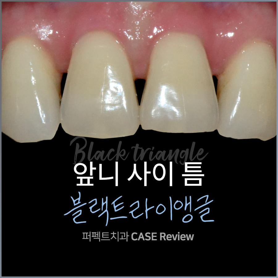 앞니 사이 틈, 블랙트라이앵글 치료방법 어렵지 않아요. 관련 이미지 1