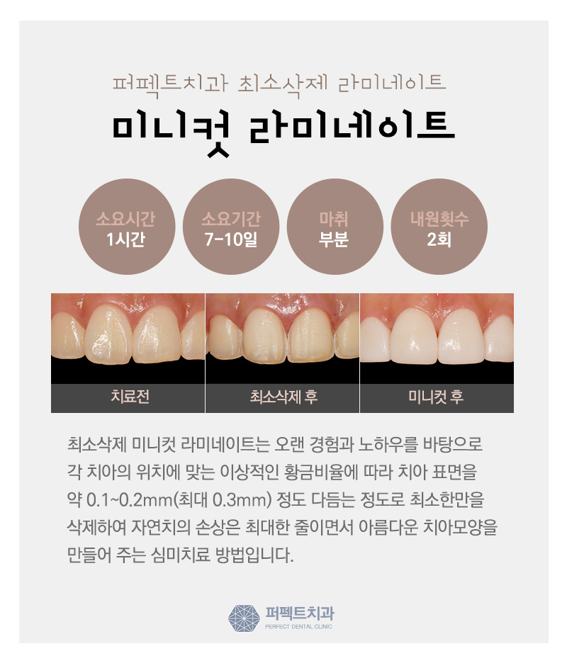 앞니 라미네이트 관련 이미지 9