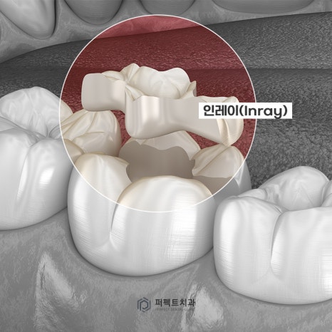 치과 치료 후 이가 시려요! 괜찮은건가요? 관련 이미지 3