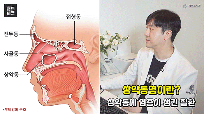 치통의 원인이 될 수 있는 상악동염이란? 관련 이미지 2