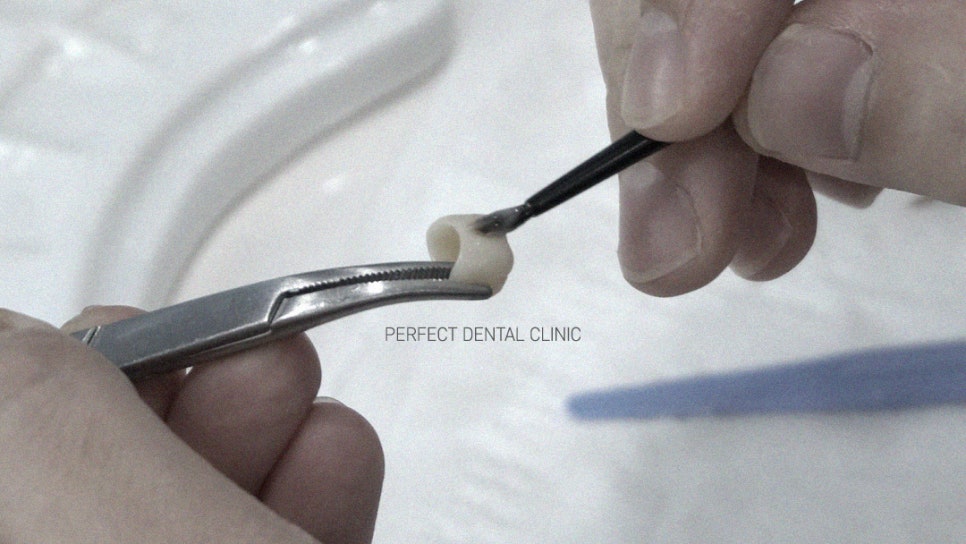 임시치아가 떨어졌어요! 관련 이미지 3