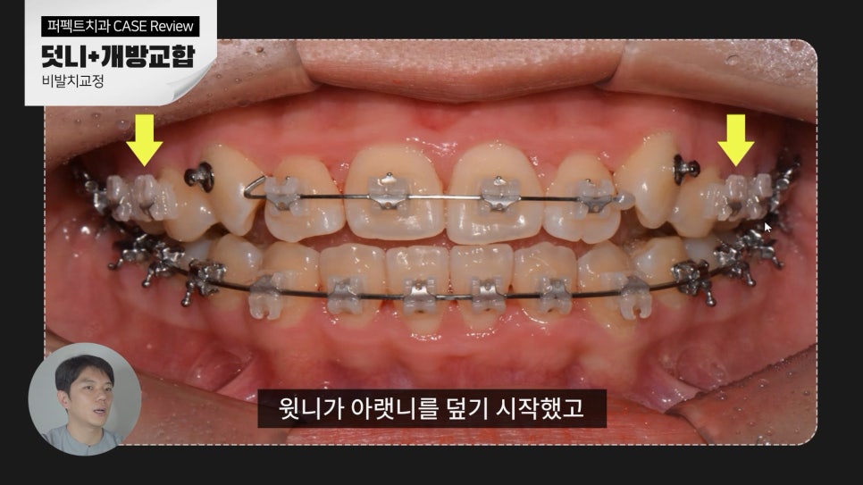 덧니+개방교합, MARPE를 이용한 비발치교정 관련 이미지 9