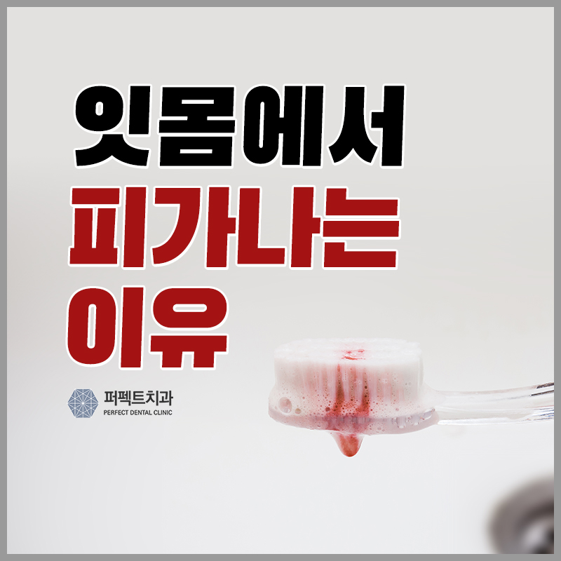 잇몸에서 피가 나는 이유 5가지 관련 이미지 1