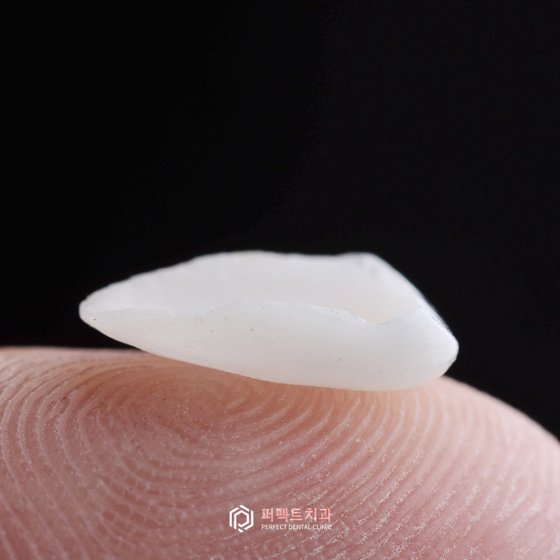 무삭제라미네이트도 단점이? 솔직한 장단점 알아보기! 관련 이미지 2