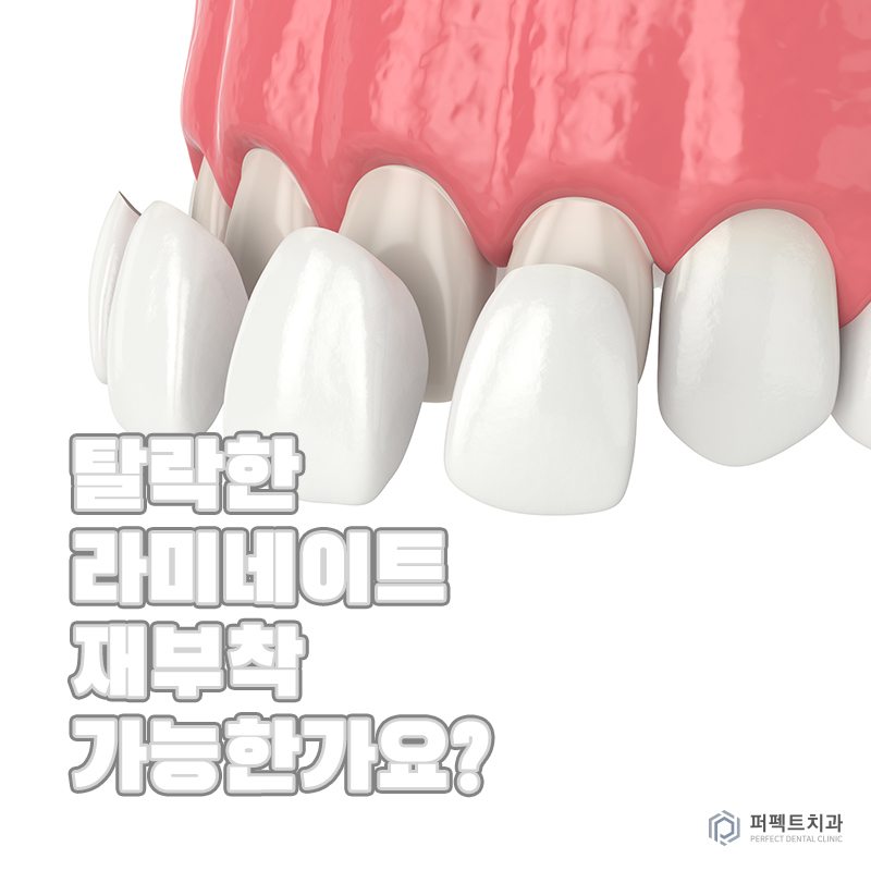 탈락한 라미네이트 재부착 가능할까요? 관련 이미지 1