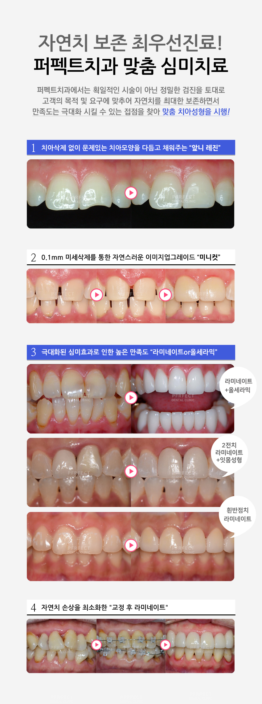 퍼펙트치치과 "0.1mm 미니컷 라미네이트" 관련 이미지 6