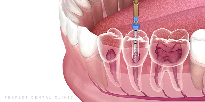 충치치료 지르코니아 크라운 가격! 관련 이미지 5