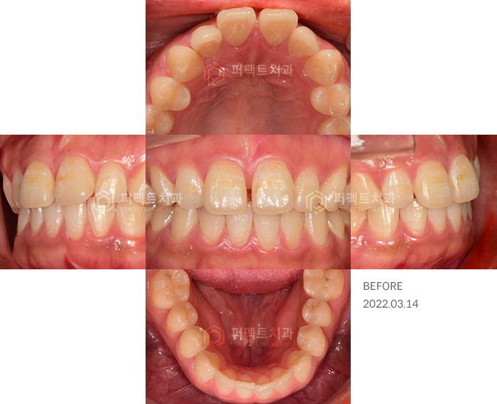 앞니 돌출,벌어짐,변색.. 교정이 싫다면 이 방법으로!? 관련 이미지 2
