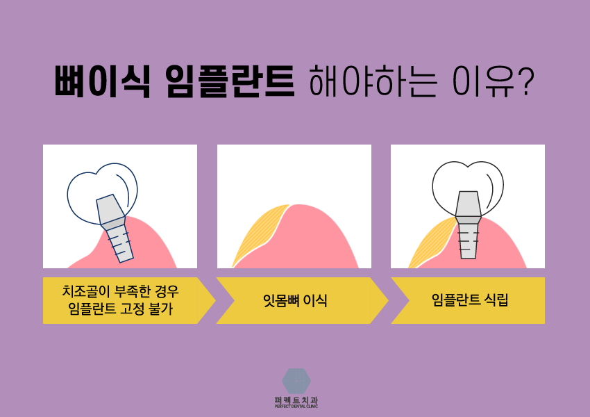 내가 뼈이식임플란트를 해야된다고? 관련 이미지 7