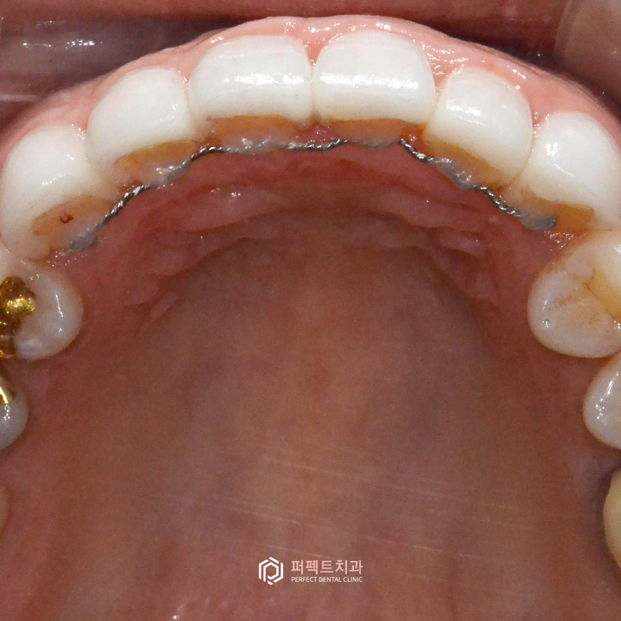 라미네이트 후 교정 유지장치는? 관련 이미지 5
