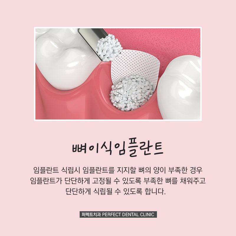 임플란트시 뼈이식이 필요한 경우 관련 이미지 2
