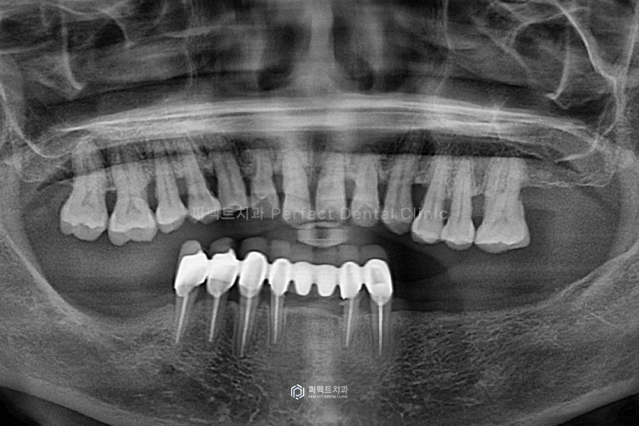 윗니 전체 신경치료 했다고?😱 교합평면이 뭐길래 관련 이미지 2