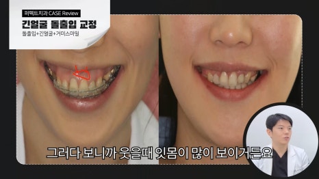 긴얼굴교정 수술없이 해결! 관련 이미지 4
