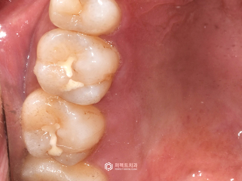 충치치료 인레이, 어떤 경우에? 관련 이미지 5